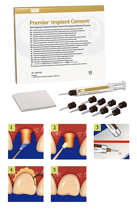 Premier - Cemento de Resina para Implantes - Kit Completo